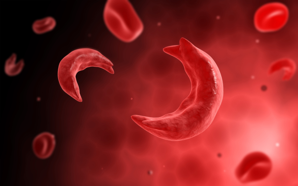Tanzania: Gov’t Unveils Technology to Combat Sickle Cell