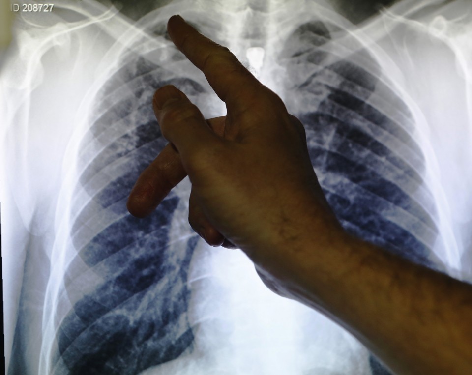 Extensively Drug-Resistant TB on the Rise in South Africa