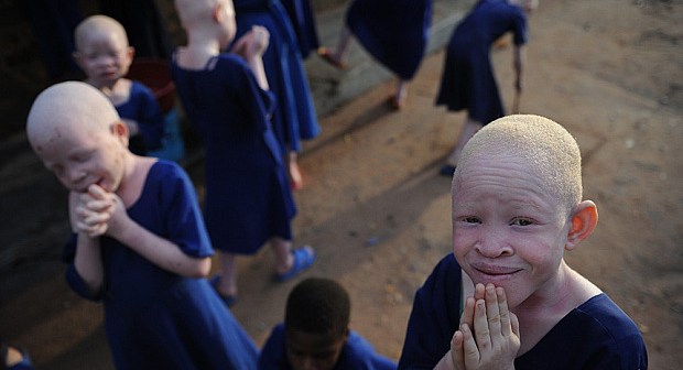 How Malawi Can End Attacks on Albinos