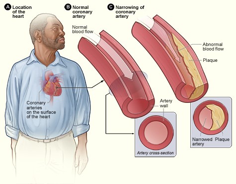 Preventing High blood pressure – Yomi Henry-eyo