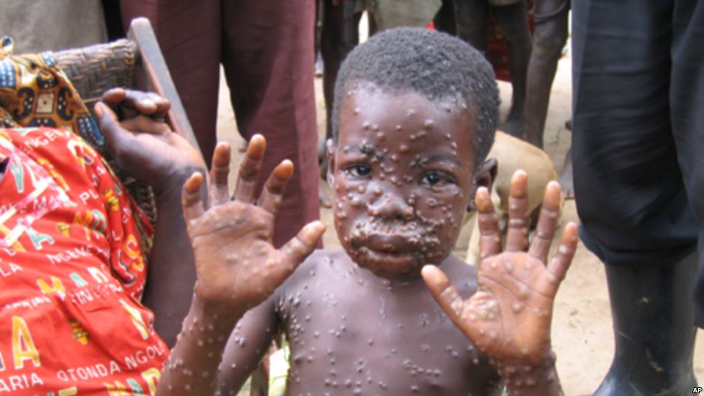 Nigeria: Kano State  Seek Preventive Measures to Curb the Wide Spread of Monkey Pox