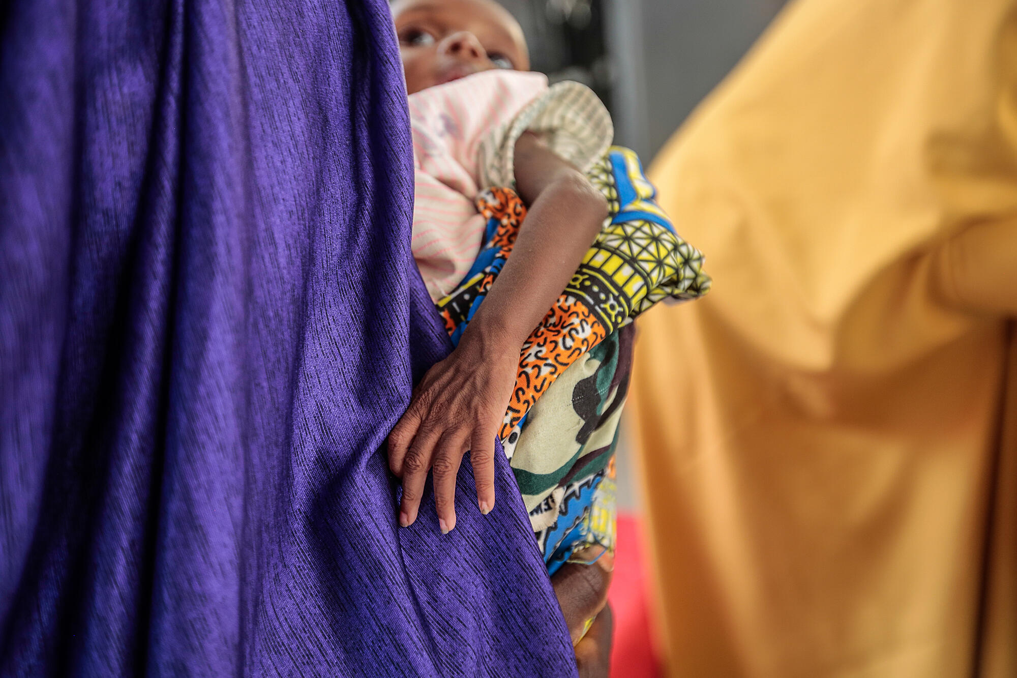 Northwest Nigeria: Medical Group Urges UN for Intervention over Malnourished Children